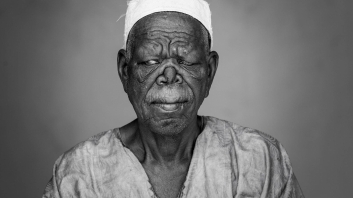 Mballing Löwengesicht Lepra